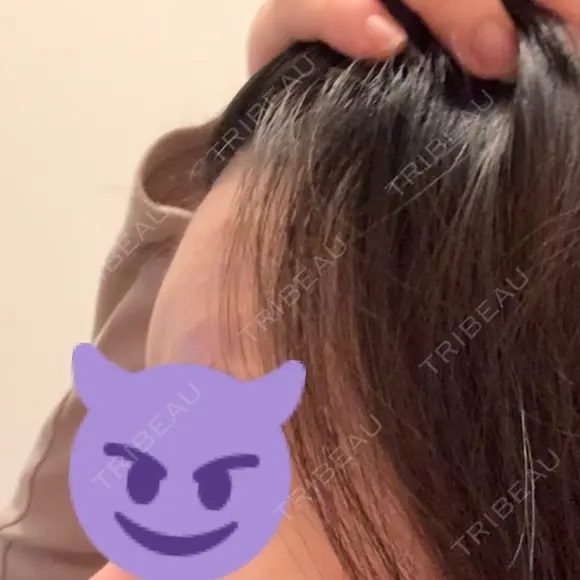 ボトックス（あご） / ヒアルロン酸注入（額） 心斎橋形成外科スキンケアクリニック DAY 0 メイン用