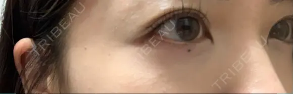 アートメイク（ほくろ） oneUPclinic DAY 0 メイン用