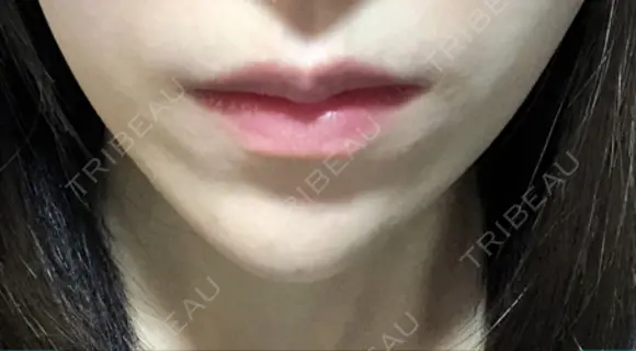ヒアルロン酸注入（あご） ASTRA BEAUTY CLINIC AFTER メイン用