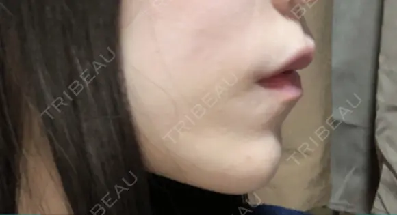 ヒアルロン酸注入（あご） ASTRA BEAUTY CLINIC DAY 2 メイン用