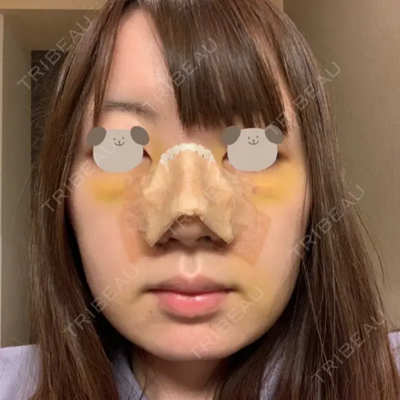 鼻尖形成（切開） / 小鼻縮小（切開） / 軟骨移植 / 骨切幅寄せ / 小鼻縮小（非切開） WOM CLINIC GINZA （ワム クリニック ギンザ） AFTER メイン用