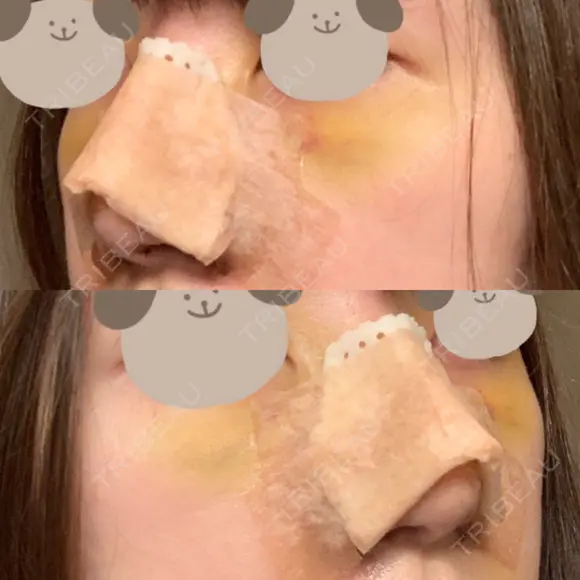 鼻尖形成（切開） / 小鼻縮小（切開） / 軟骨移植 / 骨切幅寄せ / 小鼻縮小（非切開） WOM CLINIC GINZA （ワム クリニック ギンザ） DAY 4 メイン用