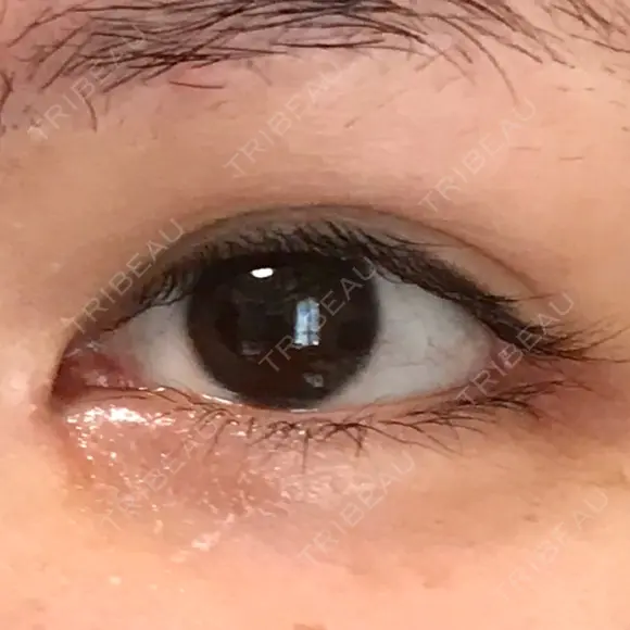 目頭切開 / 目尻切開 / 目尻靭帯移動 FROM B整形外科 (旧バウム整形外科) DAY 72 メイン用