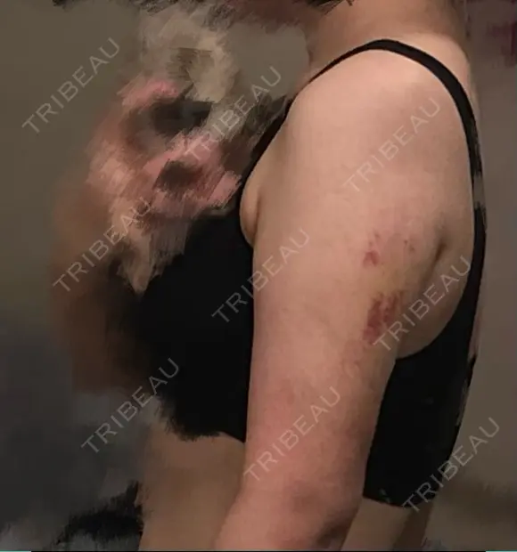 脂肪吸引（二の腕） アムルーズ美容外科クリニック 大阪院 DAY 20 メイン用