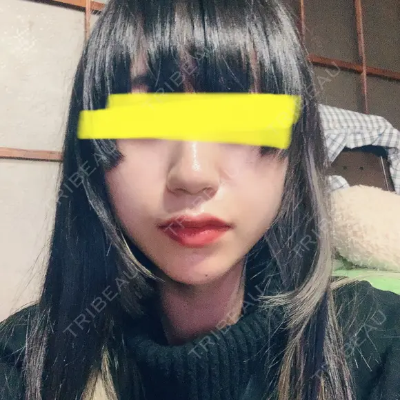 下まぶたたるみ取り / ヒアルロン酸注入（あご） / ボトックス（エラ・小顔） コスメディカルクリニック シンシア 銀座院 AFTER メイン用