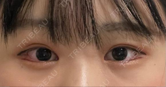 ヒアルロン酸注入（涙袋） プリモ麻布十番クリニック DAY 9 メイン用