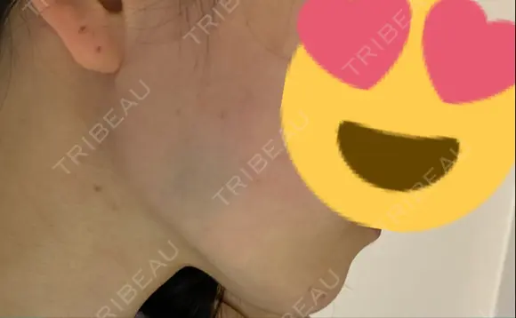 ボトックス（エラ・小顔） TCB東京中央美容外科 上野院 DAY 1 メイン用