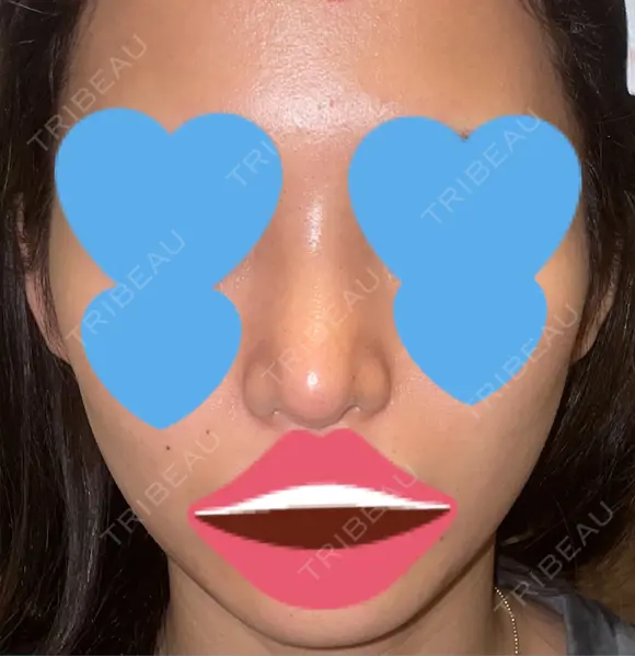 隆鼻術 / 鼻尖形成（切開） / 糸リフト / 軟骨移植 / ヒアルロン酸注入（頬） ASTRA BEAUTY CLINIC AFTER メイン用