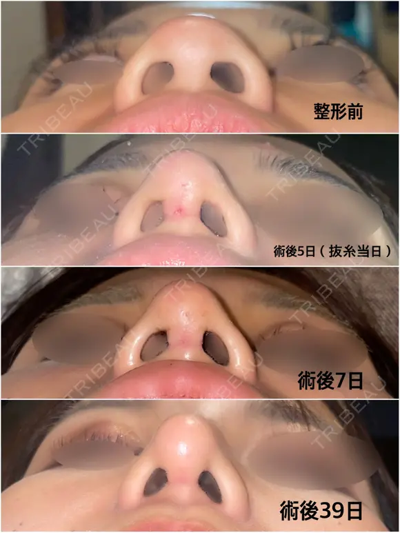 隆鼻術 / 鼻尖形成（切開） / 糸リフト / 軟骨移植 / ヒアルロン酸注入（頬） ASTRA BEAUTY CLINIC DAY 42 メイン用