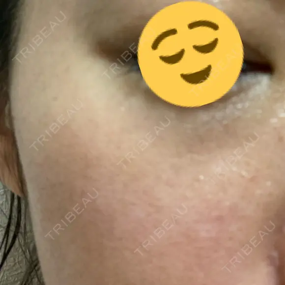 シミ取りレーザー / ピコレーザートーニング（美白・肝斑） Olino美容外科・美容皮膚科 DAY 6 メイン用