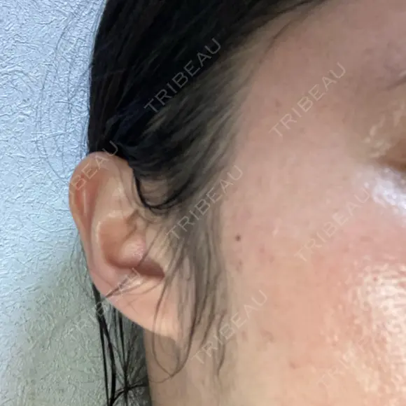 シミ取りレーザー / ピコレーザートーニング（美白・肝斑） Olino美容外科・美容皮膚科 DAY 6 メイン用