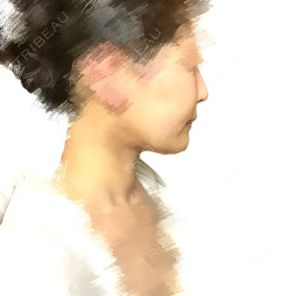 骨切り（あご） / 脂肪吸引（顔） 銀座マイアミ美容外科 DAY 118 メイン用