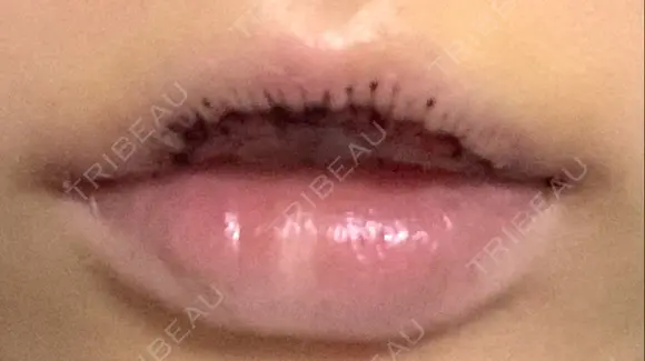 口唇縮小術 B-LINE CLINIC 池袋院 DAY 3 メイン用