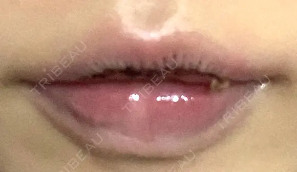 口唇縮小術 B-LINE CLINIC 池袋院 DAY 4 メイン用