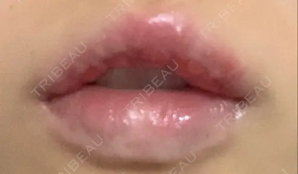 口唇縮小術 B-LINE CLINIC 池袋院 DAY 7 メイン用