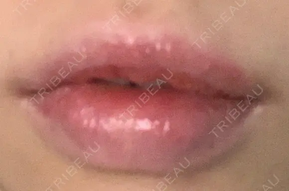 口唇縮小術 B-LINE CLINIC 池袋院 DAY 8 メイン用