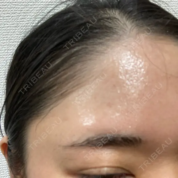 シミ取りレーザー / ピコレーザートーニング（美白・肝斑） Olino美容外科・美容皮膚科 DAY 7 メイン用
