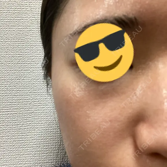 シミ取りレーザー / ピコレーザートーニング（美白・肝斑） Olino美容外科・美容皮膚科 DAY 7 メイン用