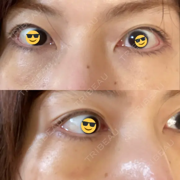 下まぶたの脂肪取り / ヒアルロン酸注入（目の下） 心斎橋形成外科スキンケアクリニック AFTER メイン用