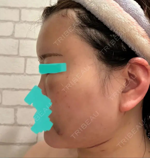 糸リフト / クマ治療 / 脂肪吸引（顔） / 脂肪注入（額） / ヒアルロン酸注入（あご） / ボトックス（エラ・小顔） / 脂肪注入（輪郭） / ボトックス（額） X CLINIC 福岡天神院 DAY 2 メイン用