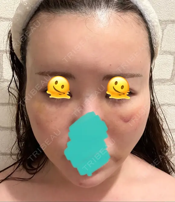 糸リフト / クマ治療 / 脂肪吸引（顔） / 脂肪注入（額） / ヒアルロン酸注入（あご） / ボトックス（エラ・小顔） / 脂肪注入（輪郭） / ボトックス（額） X CLINIC 福岡天神院 DAY 8 メイン用