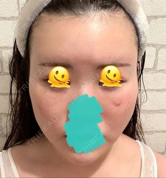 糸リフト / クマ治療 / 脂肪吸引（顔） / 脂肪注入（額） / ヒアルロン酸注入（あご） / ボトックス（エラ・小顔） / 脂肪注入（輪郭） / ボトックス（額） X CLINIC 福岡天神院 DAY 14 メイン用