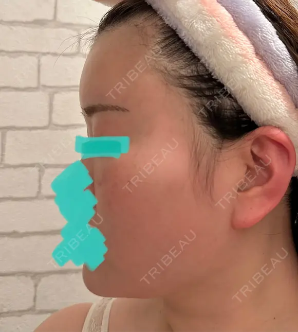 糸リフト / クマ治療 / 脂肪吸引（顔） / 脂肪注入（額） / ヒアルロン酸注入（あご） / ボトックス（エラ・小顔） / 脂肪注入（輪郭） / ボトックス（額） X CLINIC 福岡天神院 DAY 14 メイン用