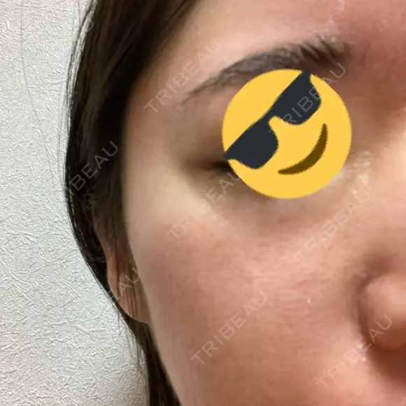 シミ取りレーザー / ピコレーザートーニング（美白・肝斑） Olino美容外科・美容皮膚科 AFTER メイン用