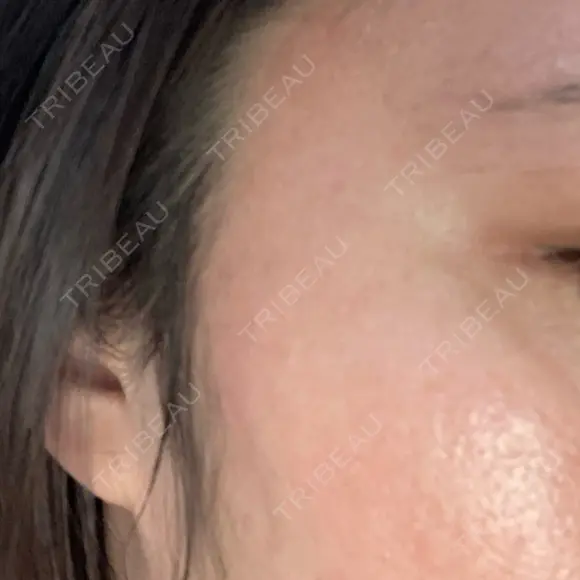 シミ取りレーザー / ピコレーザートーニング（美白・肝斑） Olino美容外科・美容皮膚科 DAY 8 メイン用