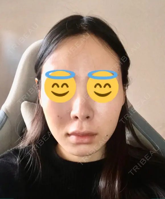 鼻尖形成（切開） / 軟骨移植 JUN CLINIC AFTER メイン用