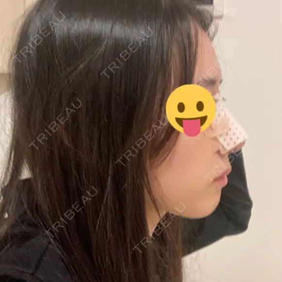 鼻尖形成（切開） / 鼻中隔延長（切開） / 小鼻縮小（切開） / 軟骨移植 / 骨切幅寄せ / ワシ鼻修正・ハンプ切除 / 鼻尖縮小 HANABI整形外科 DAY 7 メイン用