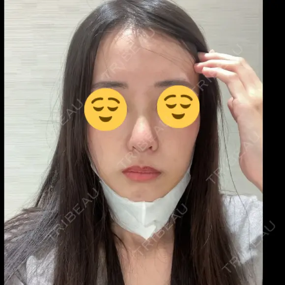 鼻尖形成（切開） / 鼻中隔延長（切開） / 小鼻縮小（切開） / 軟骨移植 / 骨切幅寄せ / ワシ鼻修正・ハンプ切除 / 鼻尖縮小 HANABI整形外科 DAY 8 メイン用