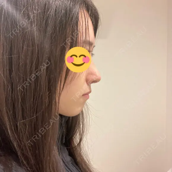 鼻尖形成（切開） / 鼻中隔延長（切開） / 小鼻縮小（切開） / 軟骨移植 / 骨切幅寄せ / ワシ鼻修正・ハンプ切除 / 鼻尖縮小 HANABI整形外科 DAY 8 メイン用