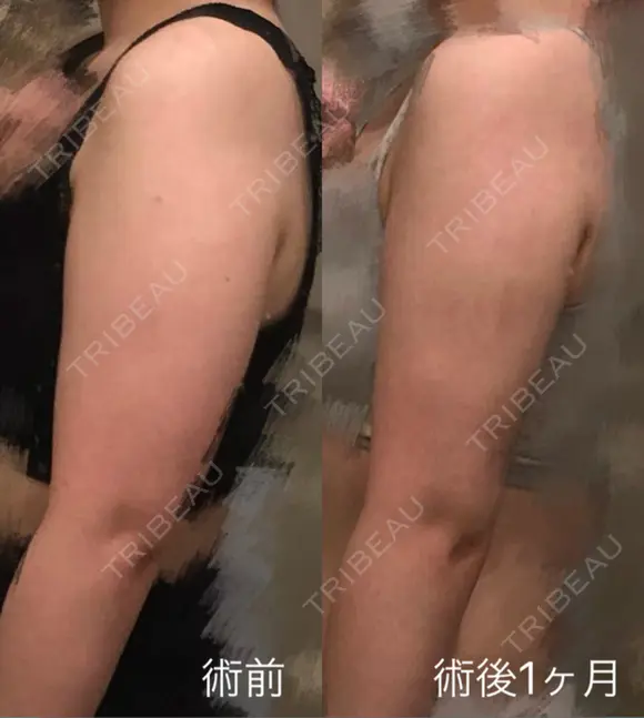 脂肪吸引（二の腕） アムルーズ美容外科クリニック 大阪院 DAY 30 メイン用