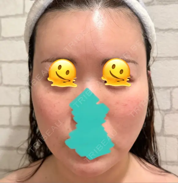 糸リフト / クマ治療 / 脂肪吸引（顔） / 脂肪注入（額） / ヒアルロン酸注入（あご） / ボトックス（エラ・小顔） / 脂肪注入（輪郭） / ボトックス（額） X CLINIC 福岡天神院 AFTER メイン用