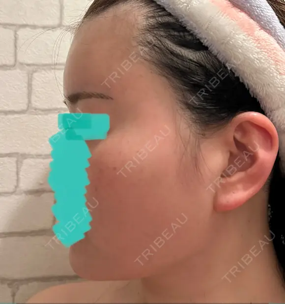 糸リフト / クマ治療 / 脂肪吸引（顔） / 脂肪注入（額） / ヒアルロン酸注入（あご） / ボトックス（エラ・小顔） / 脂肪注入（輪郭） / ボトックス（額） X CLINIC 福岡天神院 DAY 35 メイン用