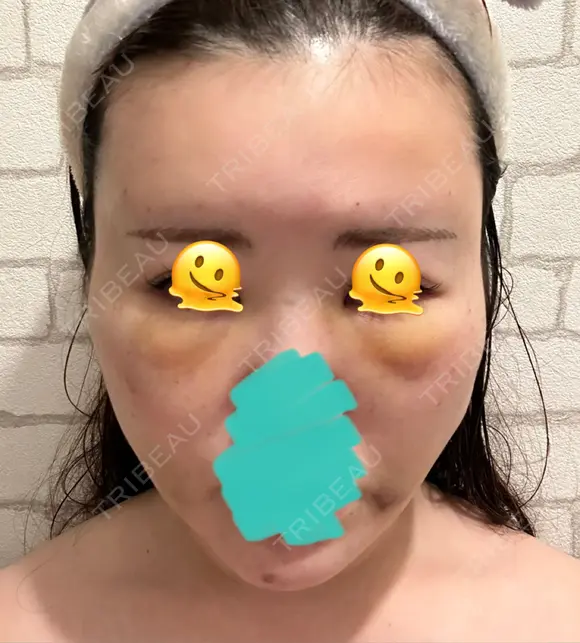 糸リフト / クマ治療 / 脂肪吸引（顔） / 脂肪注入（額） / ヒアルロン酸注入（あご） / ボトックス（エラ・小顔） / 脂肪注入（輪郭） / ボトックス（額） X CLINIC 福岡天神院 DAY 3 メイン用