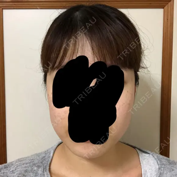 ボトックス（エラ・小顔） 湘南美容クリニック 名古屋栄院 DAY 2 メイン用