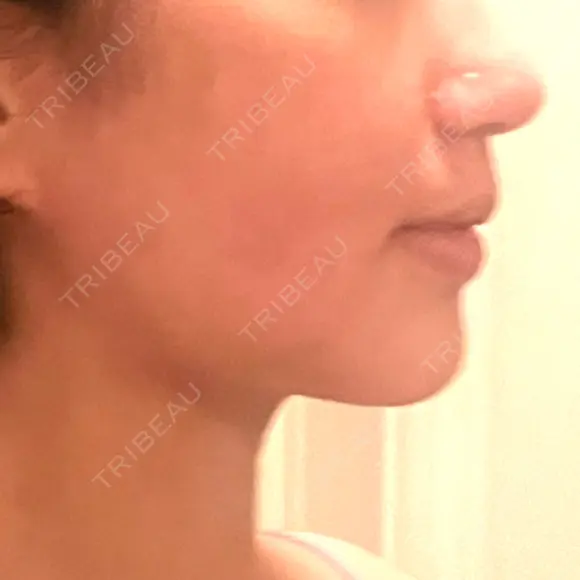 バッカルファット除去 / 脂肪吸引（顔） / ジョールファット除去 WOM CLINIC GINZA （ワム クリニック ギンザ） DAY 35 メイン用