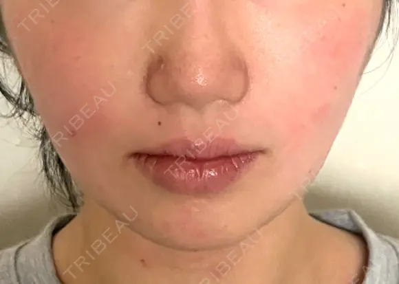 バッカルファット除去 / 脂肪吸引（顔） / ジョールファット除去 WOM CLINIC GINZA （ワム クリニック ギンザ） AFTER メイン用