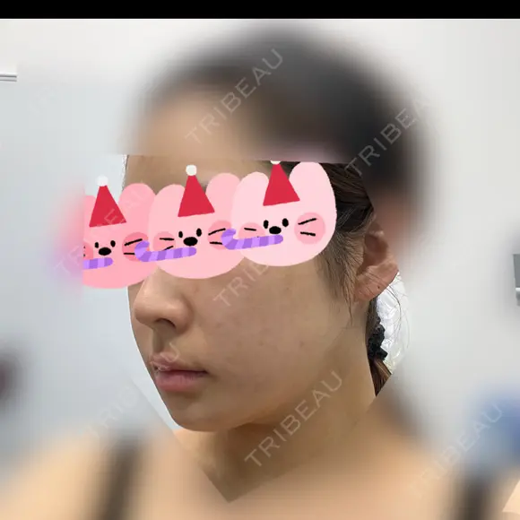 骨切り（あご） / 骨削り（エラ） / 骨削り（頬） リラ・クラニオフェイシャル・クリニック DAY 292 メイン用