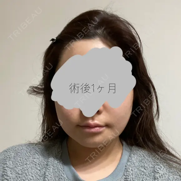 骨切り（あご） / 骨削り（エラ） / 骨削り（頬） リラ・クラニオフェイシャル・クリニック DAY 33 メイン用