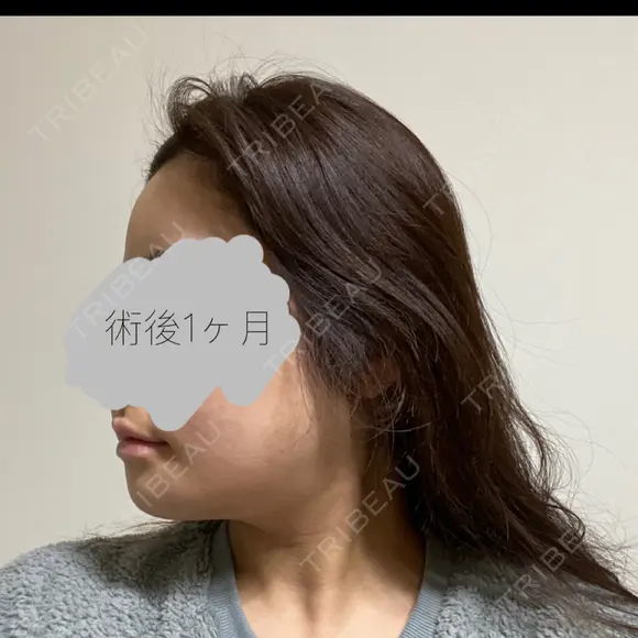 骨切り（あご） / 骨削り（エラ） / 骨削り（頬） リラ・クラニオフェイシャル・クリニック DAY 33 メイン用