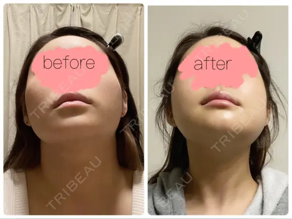 骨切り（あご） / 骨削り（エラ） / 骨削り（頬） リラ・クラニオフェイシャル・クリニック DAY 20 メイン用