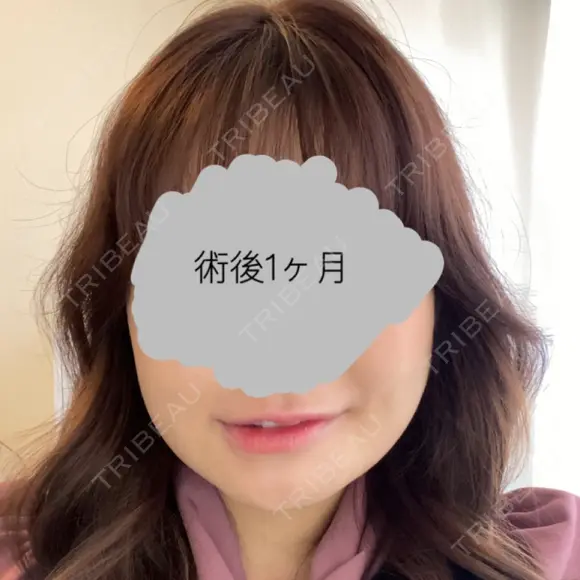 骨切り（あご） / 骨削り（エラ） / 骨削り（頬） リラ・クラニオフェイシャル・クリニック DAY 35 メイン用