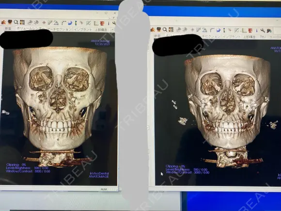 骨切り（あご） / 骨削り（エラ） / 骨削り（頬） リラ・クラニオフェイシャル・クリニック DAY 96 メイン用
