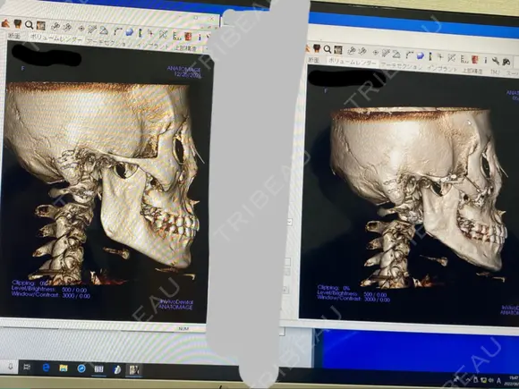 骨切り（あご） / 骨削り（エラ） / 骨削り（頬） リラ・クラニオフェイシャル・クリニック DAY 96 メイン用