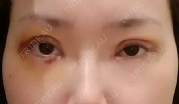 二重切開 / 目頭切開 / 眼瞼下垂（切開） / 目元修正 聖心美容クリニック 札幌院 DAY 4 メイン用