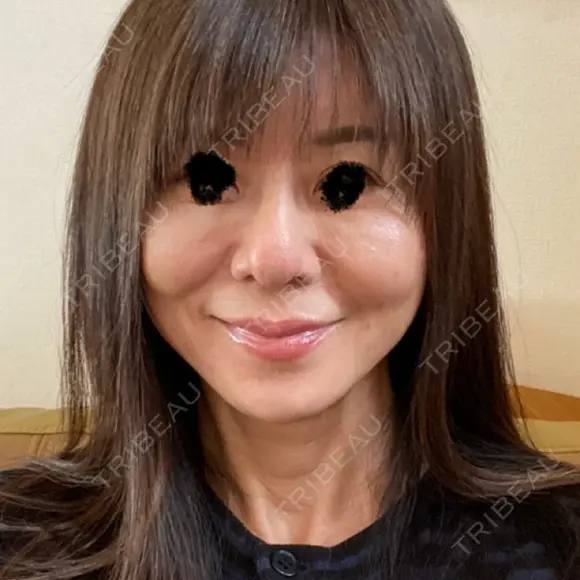 隆鼻術 / 軟骨移植 / 鼻尖縮小 エースクリニック 名古屋院 AFTER メイン用