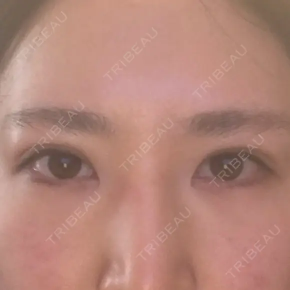二重埋没 アリエル美容クリニック 郡山院 DAY 2 メイン用